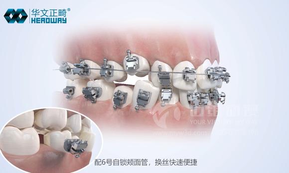 牙齿矫正医学三维动画-医学口腔三维动画-上海医学动画制作 