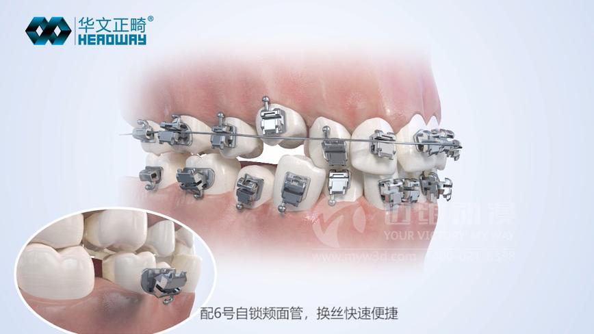 牙齿矫正医学三维动画-医学口腔三维动画-上海医学动画制作 